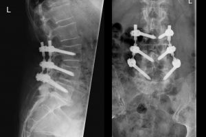 Röntgenbild einer dynamischen Spondylodese in Köln