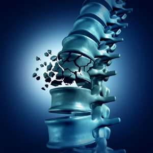 Wirbelbruch bei Osteoporose an der Wirbelsäule