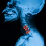Schädigung des Rückenmarks an der Halswirbelsäule