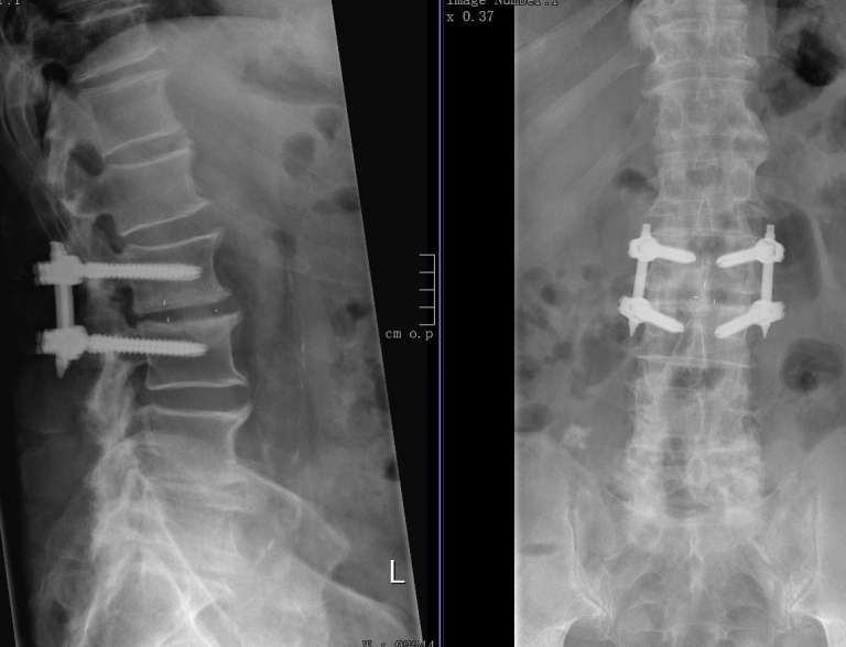 Wirbelsäulenversteifung Spondylodese OP Dr. Christopoulos