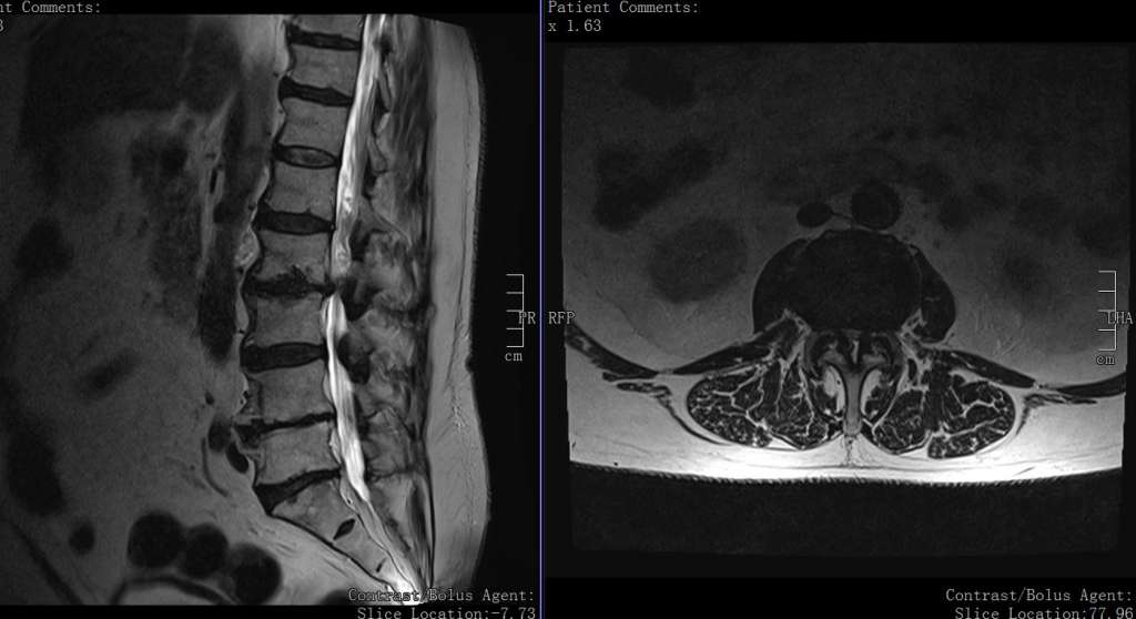 Wirbelsäulenversteifung Spondylodese OP Dr. Christopoulos Wirbelsäulenversteifung Spondylodese OP Dr. Christopoulos